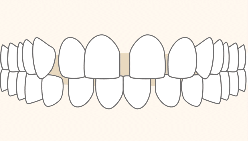 Cross bite photo