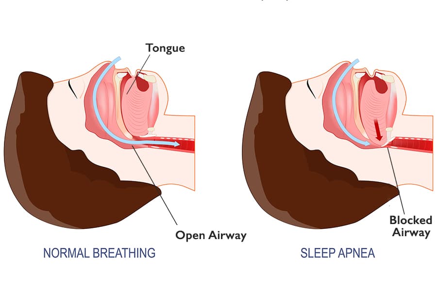 Sleep apnea photo4