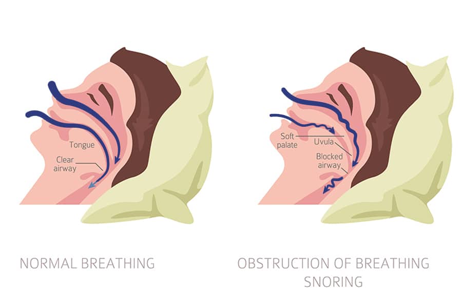 Snoring photo copy