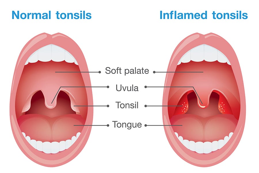 Tonsils photo